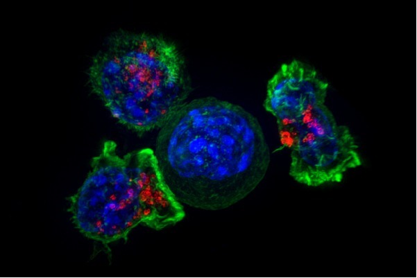 კიბოს უჯრედებზე (ფოტოზე ლურჯად) შემოხვეული T-უჯრედები (ფოტოზე წვანედ და წითლად)